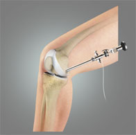 Arthroscopy