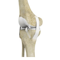 Total Knee Replacement