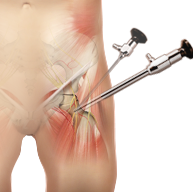  Hip Arthroscopy