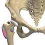 Femoro Acetabular Impingement (FAI)