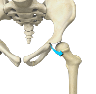 Femoro Acetabular Impingement (FAI)