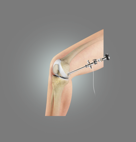 Patellofemoral Instability