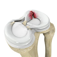 Meniscus Tear