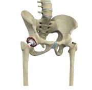  Revision Hip Replacement