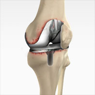 Total Knee Replacement