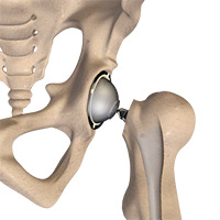  Hip Arthroscopy