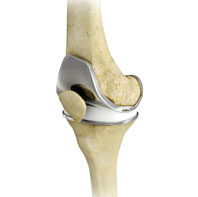 Total Knee Replacement