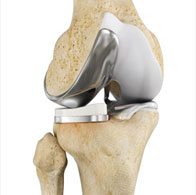  Uni Condylar Knee Replacement 