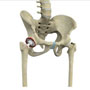 Revision Hip Replacement